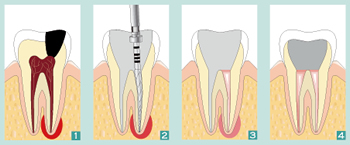 endodontie01