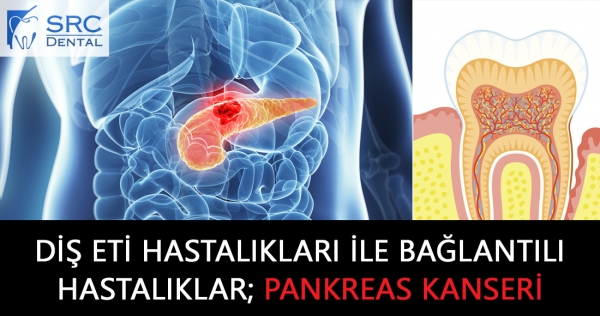 Diş eti rahatsızlıkları ile birlikte düşünülen ciddi bir hastalık; Pankreas Kanseri