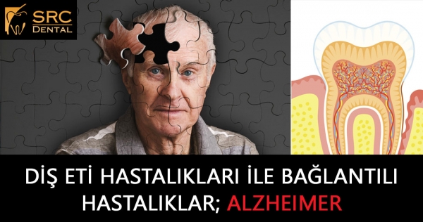 Diş Eti Hastalıkları ile Bağlantılı Hastalıklar, ALZHEIMER