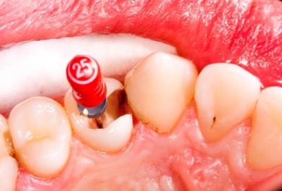 ENDODONTİ